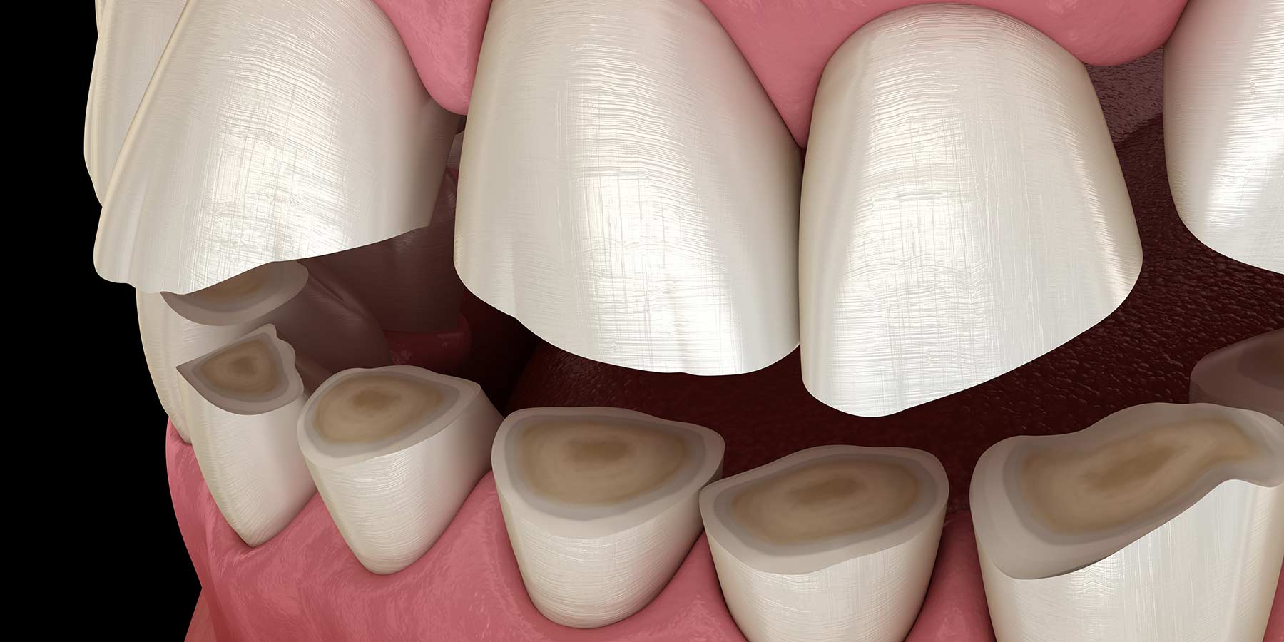 Teeth Grinding: The Signs and Symptoms of Bruxism for Adults