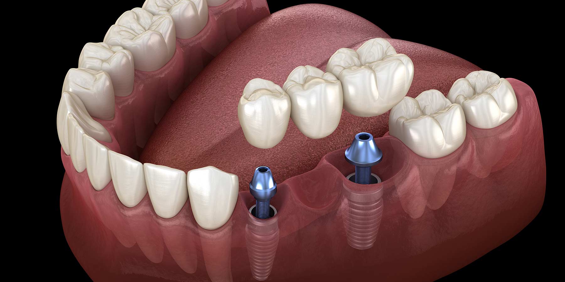 dental implants gone wrong